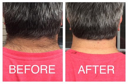Barber's Edge Hairline Trimmer - DIY Neckline trimmer - Lets you trim your own neck