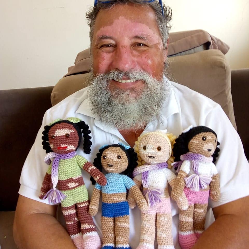 vitiligo crochet dolls - Grandfather with vitiligo skin condition creates crochet dolls