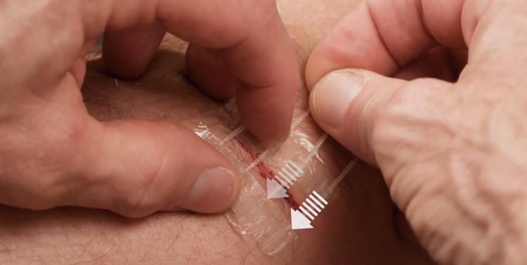 ZipStitch Home Laceration Kit Lets you heal wounds without stitches - DIY Home stitches